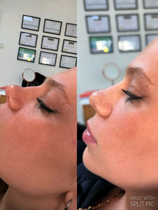 Side-by-side images of a woman's profile before and after a cosmetic procedure. Certificates hang on a wall in the blurred background.