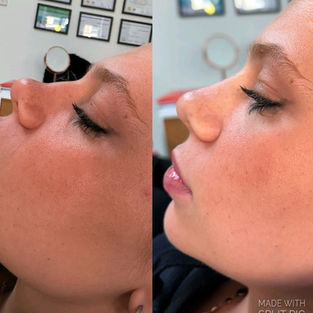 Non-Surgical Rhinoplasty in Maidstone Kent