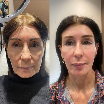 wrinkles-before-after