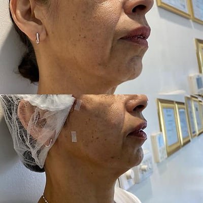 jawline-before-after