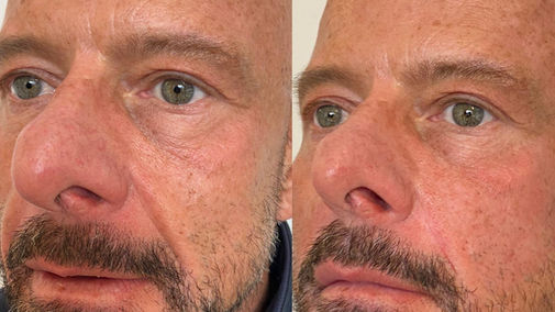 Smile Lines Treatment for Men