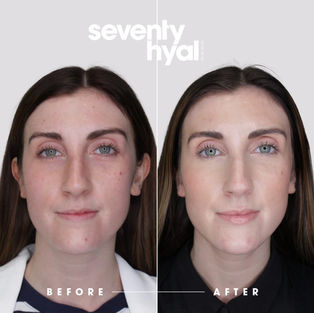 Seventy-Hyal 2000 Before and After