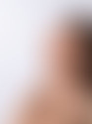 Lower Face Botox Maidstone: Jawline & Chin Refinement