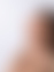 Lower Face Botox Maidstone: Jawline & Chin Refinement