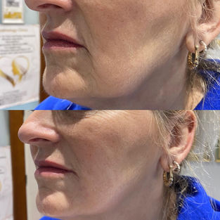 Before and After Marionnete Lines Filler in Maidstone, Kent