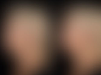 Lower Face Botox Before and After in Maidstone Kent