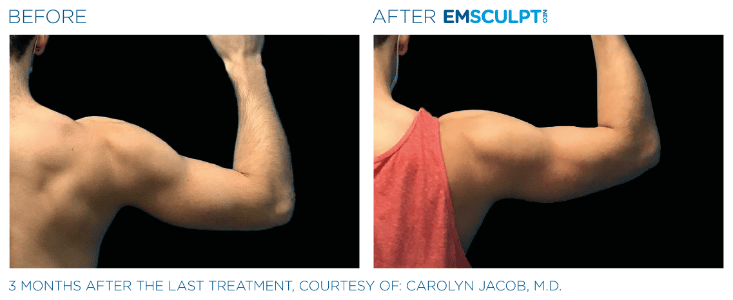 Emsculpt_Neo_PIC_Ba-card-male-arms-077_ENUS100
