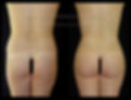 Gluteoplastia