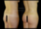 Gluteoplastia