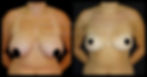 Mamoplastia de reducción