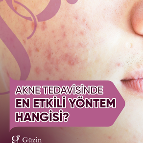 Akne Tedavisinde En Etkili Yöntem Hangisi?