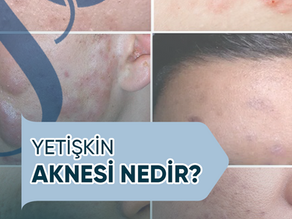 Yetişkin Aknesi Nedir?