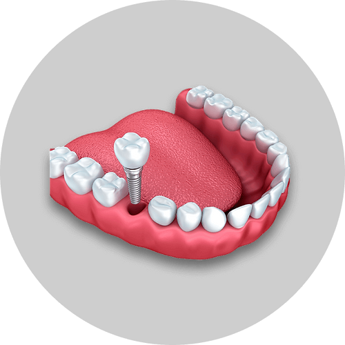 image_implant_welcome (1).png