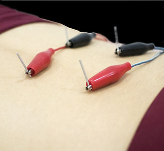 dry needling.in.fort.thomas.ky.jpeg