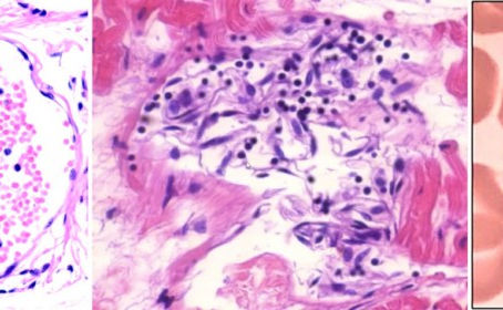 Gefäß- und Organschäden durch mRNA-Impfstoffe: unwiderlegbarer Beweis der Kausalität