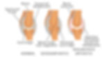 osteoarthritis vs Rheumatoid arthritis