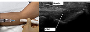 Cortisone Injection for Tennis Elbow