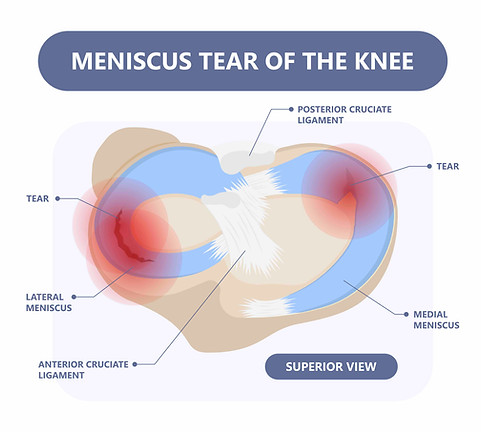 meniscal tears copy2.jpg