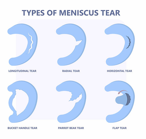 meniscal tears copy2.jpg
