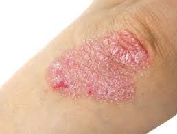 Ogni anno, il 29 ottobre si celebra la Giornata Mondiale della Psoriasi.