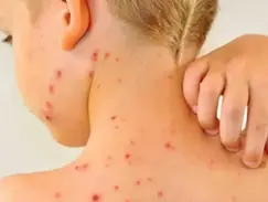 OMS y UNICEF advierten que el sarampión en Europa está a su nivel máximo en más de 25 años