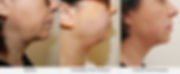 Ultraformer+HIFU+Face+&+Neck+Lift (1).jp