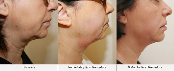 non surgical facelift