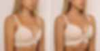 Breast Lift - Stamford, CT and Fairfield County, CT