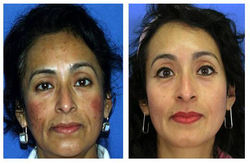 Sun Damage/Dullness