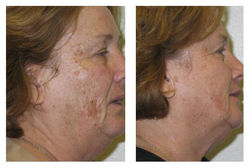 Age Spots/Sun Damage
