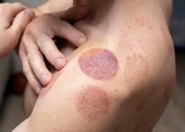 Myofascia Cupping Therapy