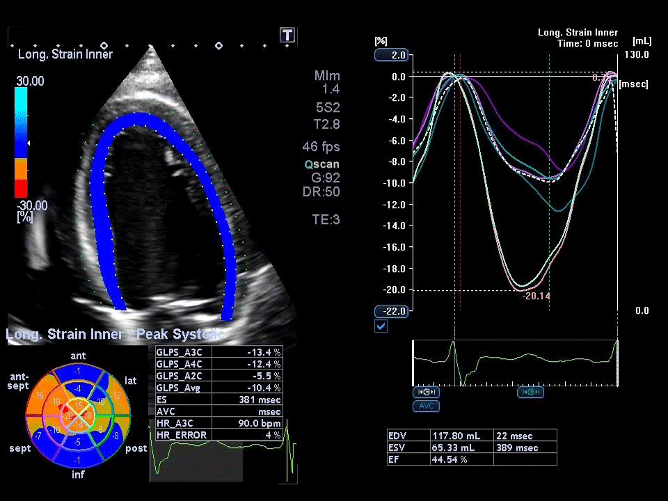 Ecocardio GIF 11.gif
