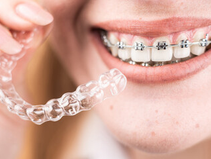 インビザラインとワイヤー矯正の違いとは？〜費用・見た目・通院回数で徹底比較〜