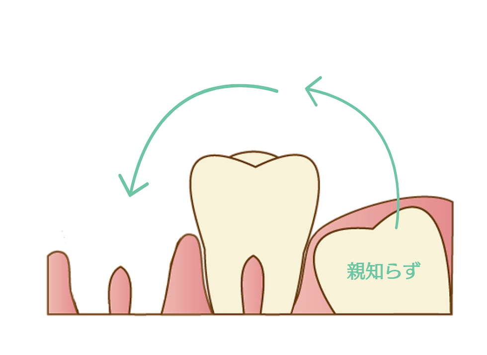 歯牙移植