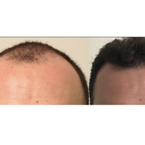 Microinjerto de cabello, técnica F.U.Excision