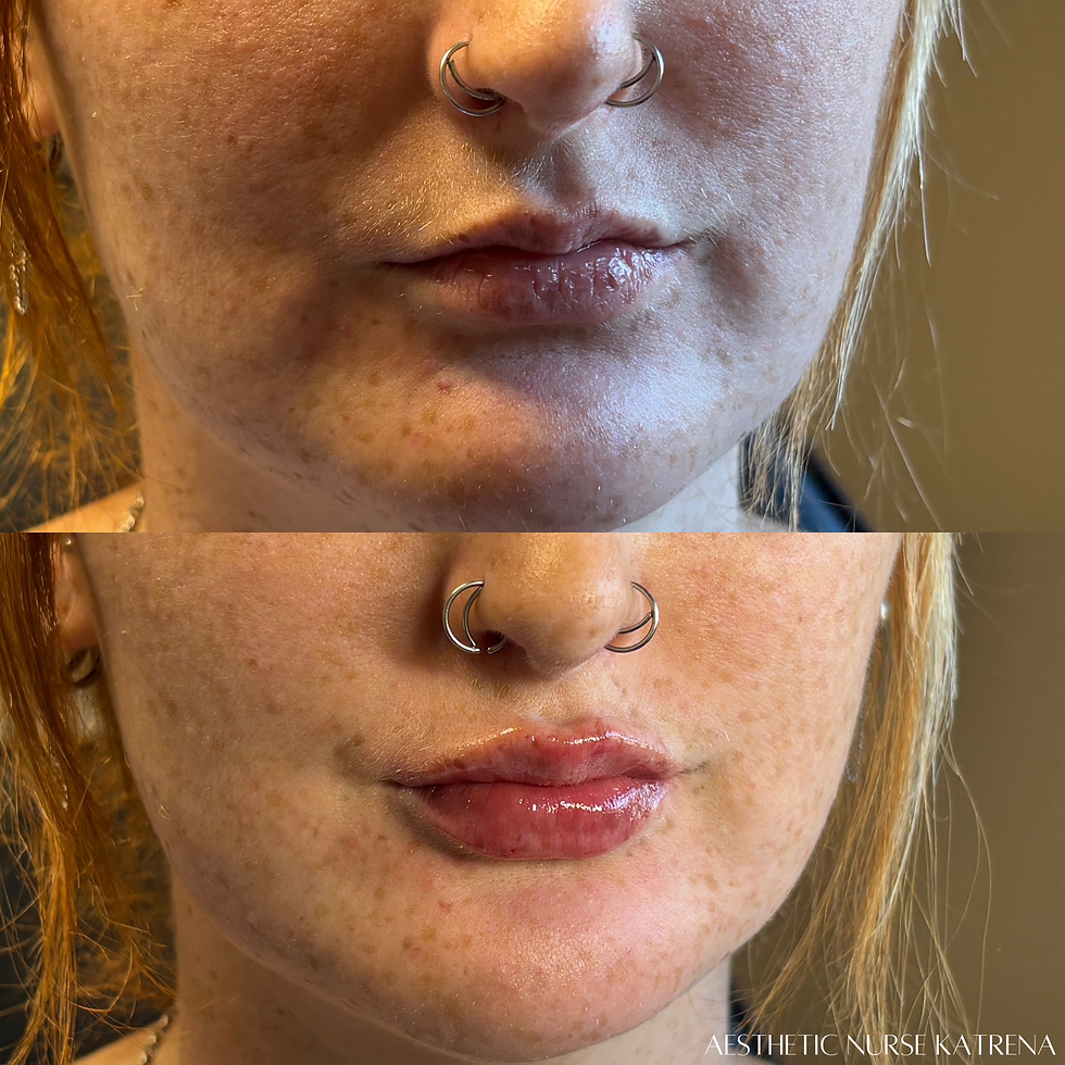 Mini Lip Filler Plump near me Oshawa | Durham Region | Courtice | Whitby | Bowmanville | Orono