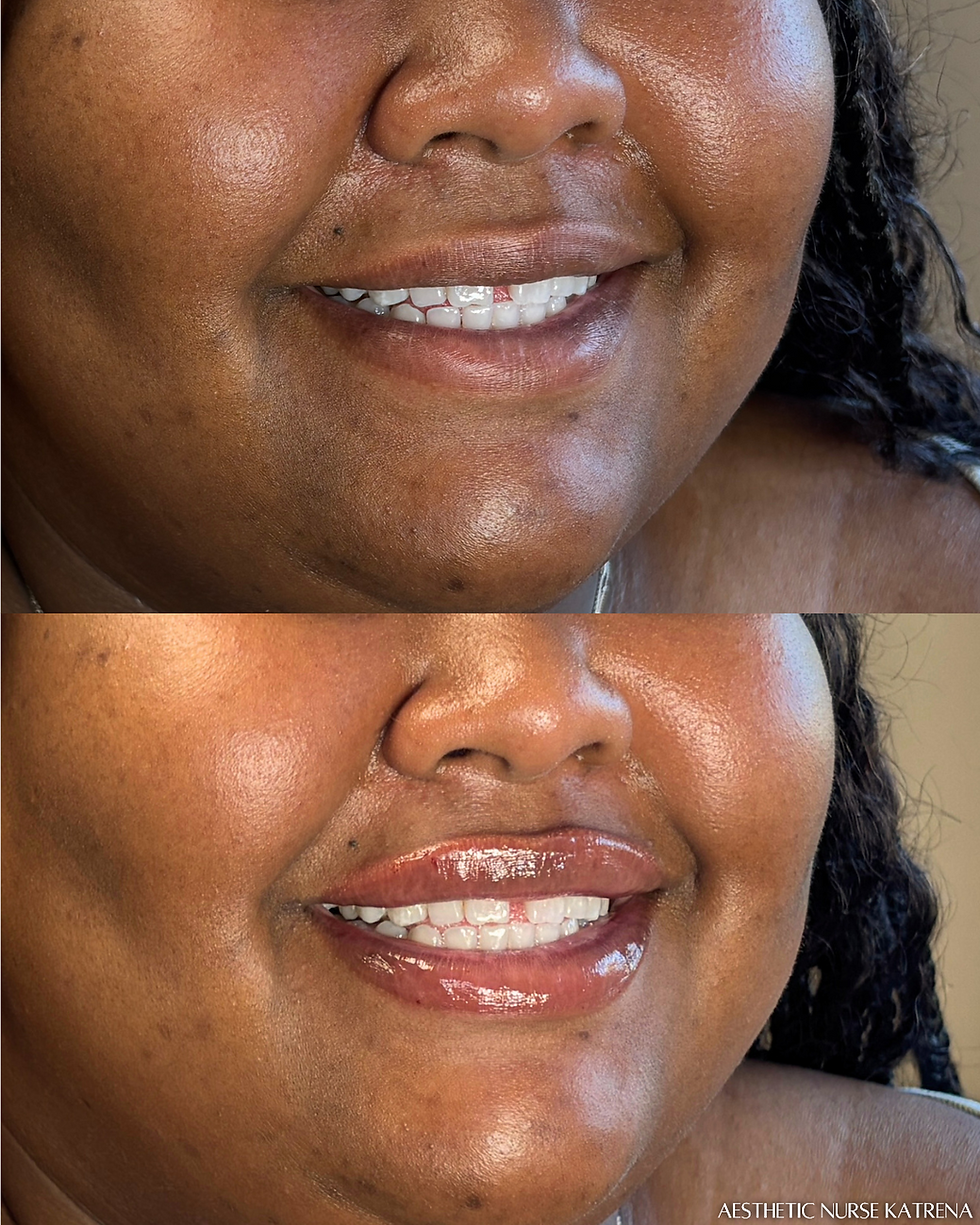 0.75mL Lip Filler near me Oshawa | Durham Region | Courtice | Whitby | Bowmanville | Orono | Ajax