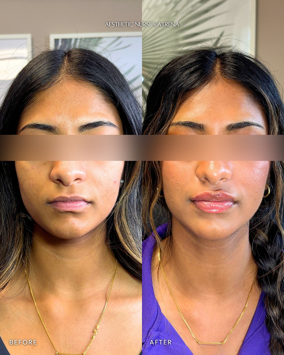 Full Lip Filler near me Oshawa | Durham Region | Courtice | Whitby | Bowmanville | Orono | Ajax