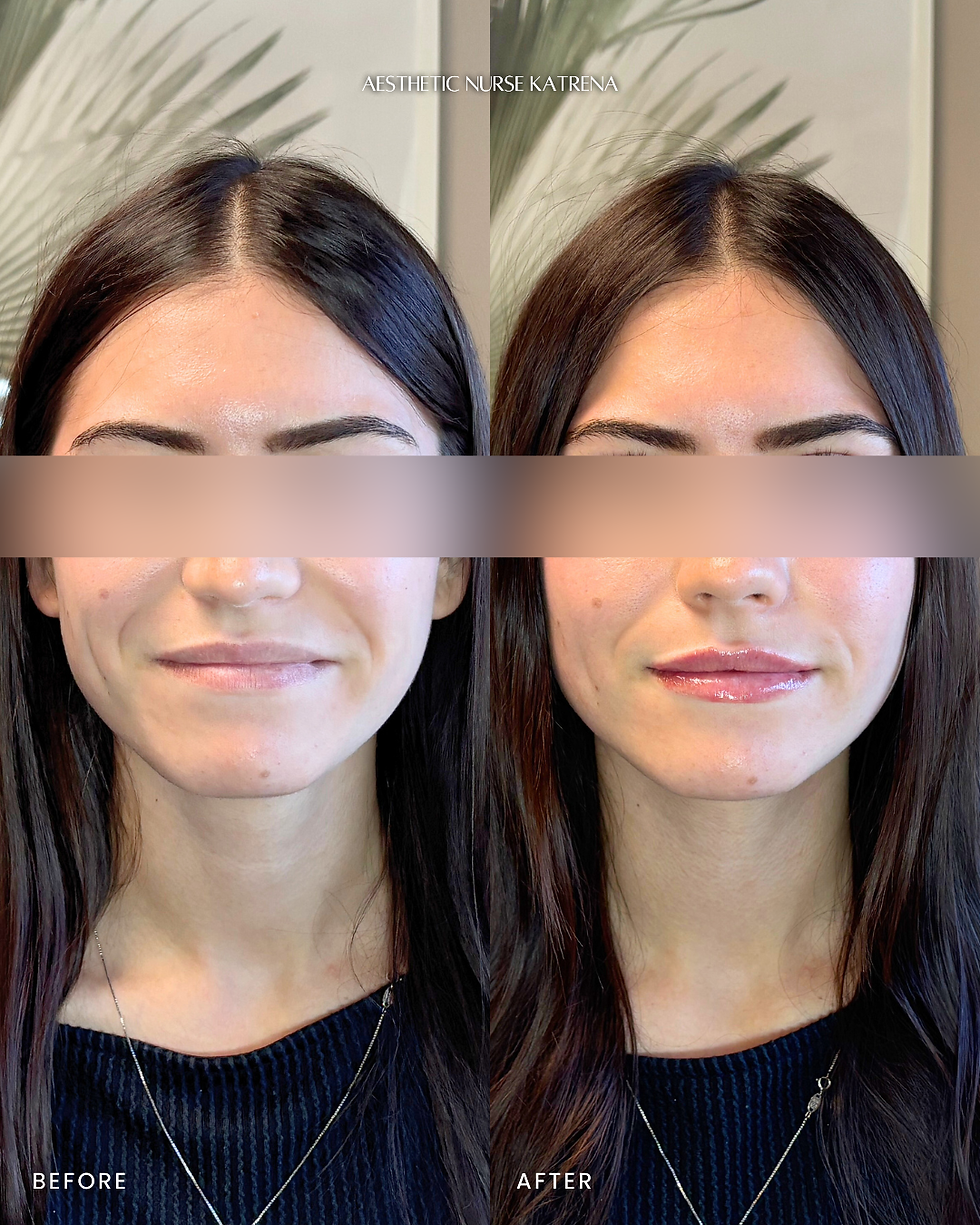 Mini Lip Filler near me Oshawa | Durham Region | Courtice | Whitby | Bowmanville | Orono | Ajax