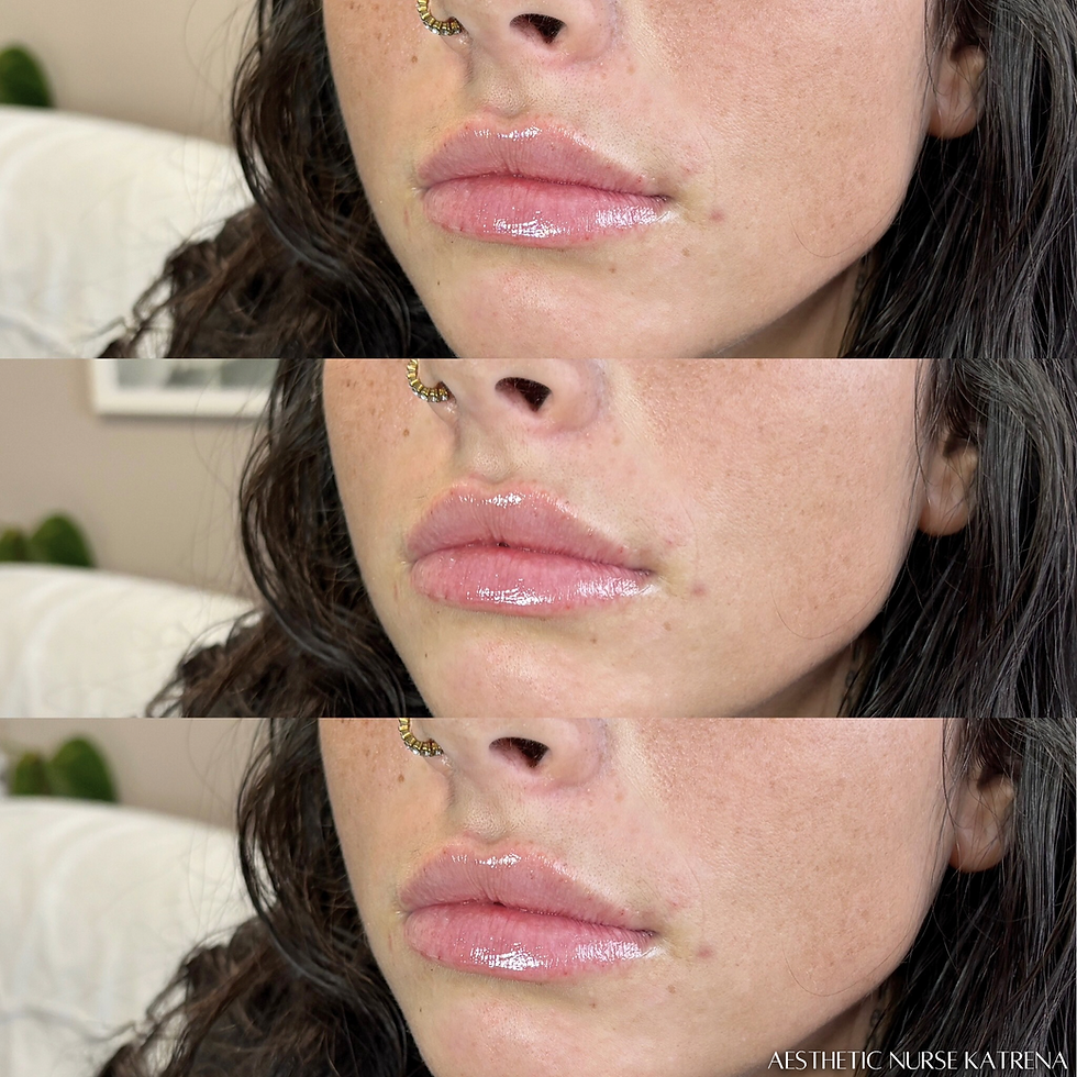 Mini Lip Filler Plump near me Oshawa | Courtice | Whitby | Bowmanville | Orono | Ajax