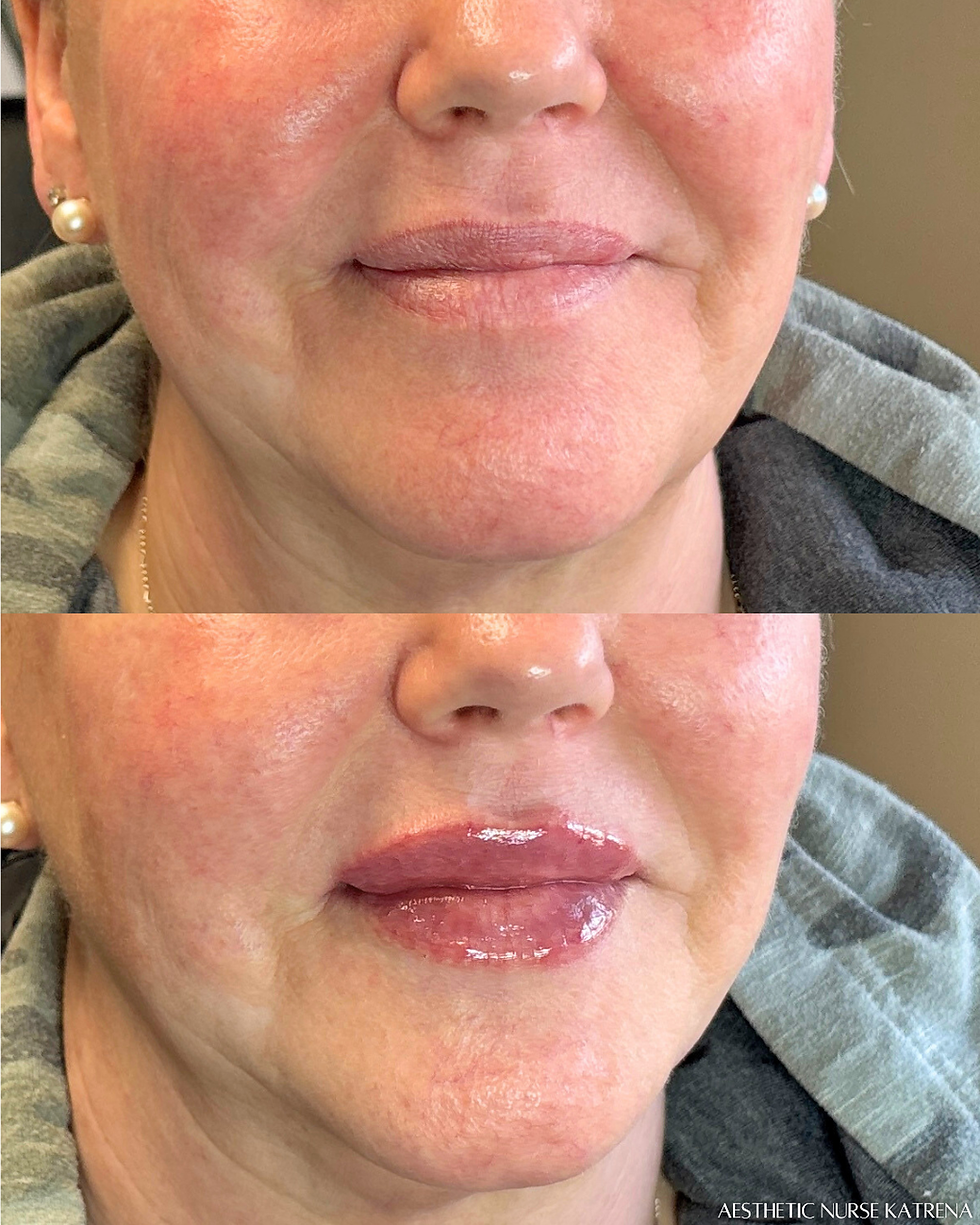 Mini Lip Filler near me Oshawa | Courtice | Whitby | Bowmanville | Orono | Newcastle | Ajax