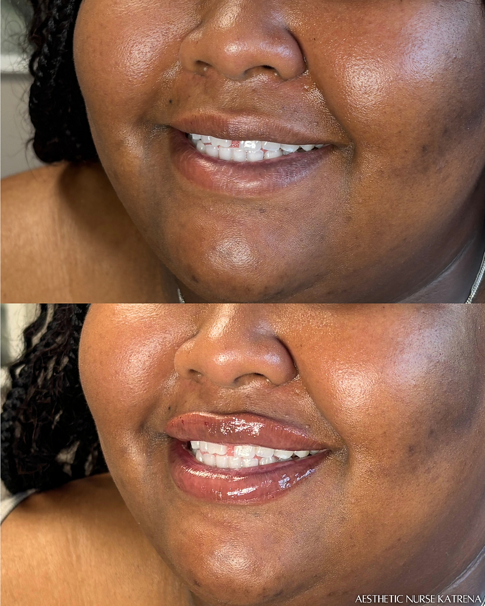 0.75mL Lip Filler near me Oshawa | Durham Region | Courtice | Whitby | Bowmanville | Orono | Ajax