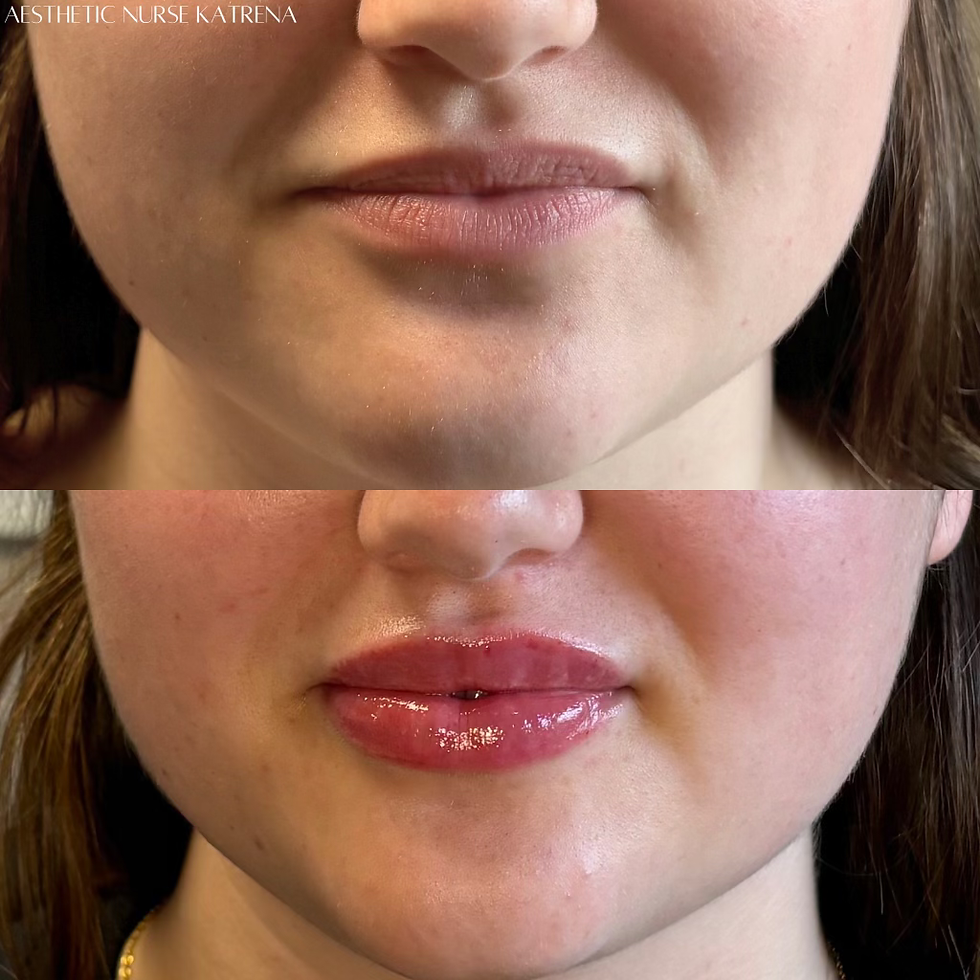Full Lip Filler Plump near me Oshawa | Durham Region | Courtice | Whitby | Bowmanville | Orono