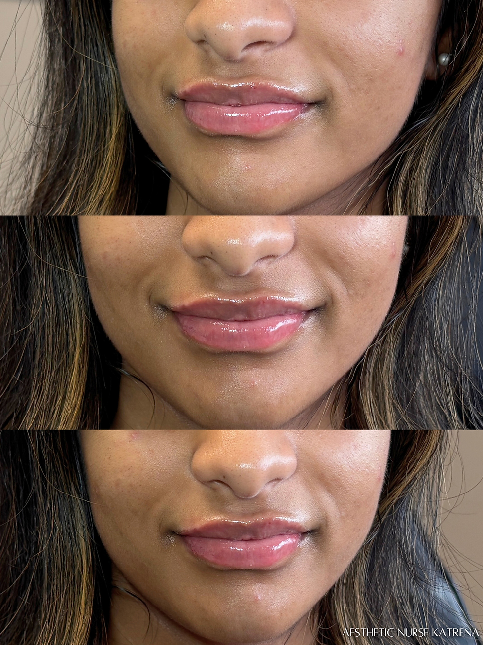 Mini Lip Filler near me Oshawa | Courtice | Whitby | Bowmanville | Orono | Newcastle | Ajax