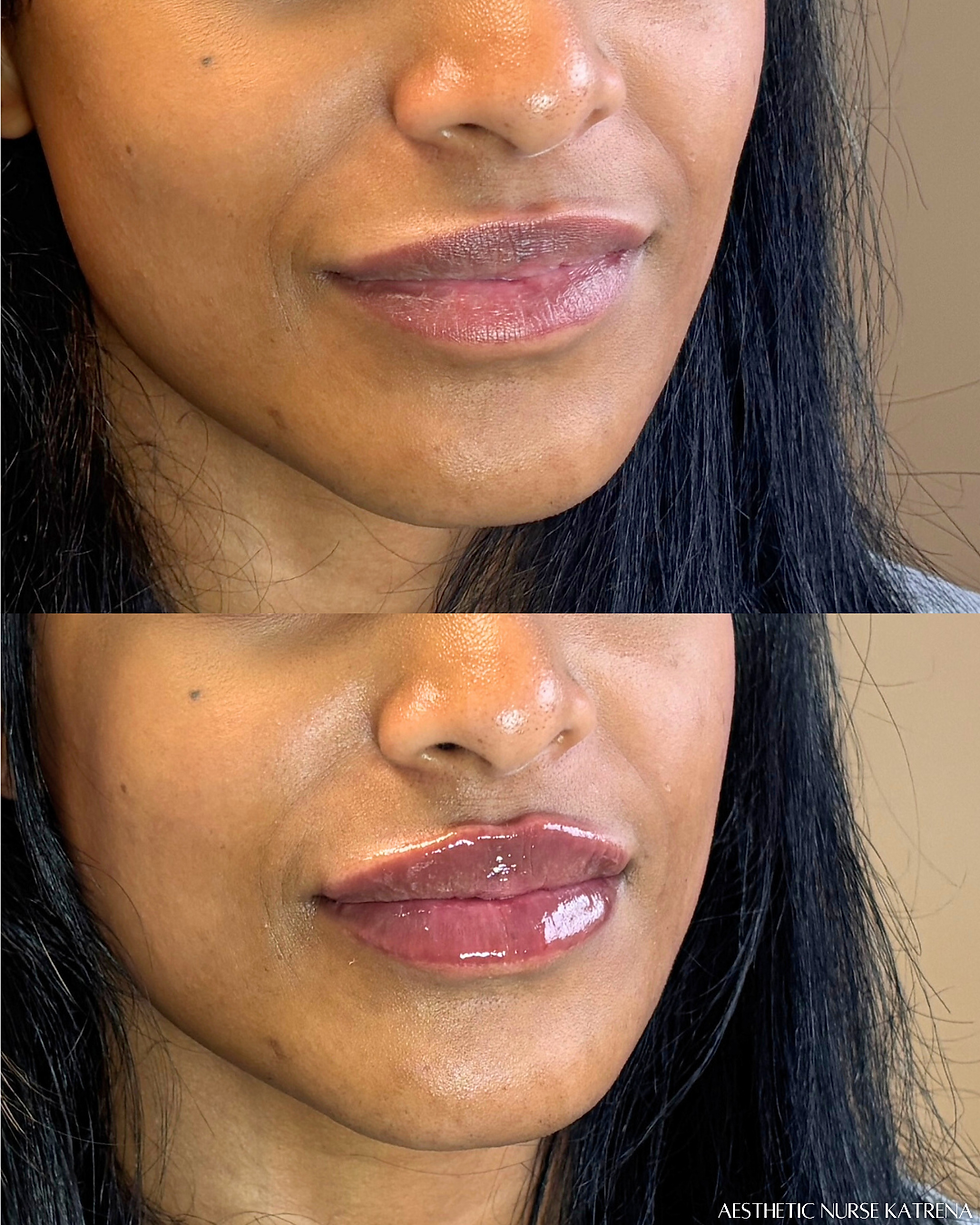 Mini Lip Filler near me Oshawa | Durham Region | Courtice | Whitby | Bowmanville | Orono | Ajax