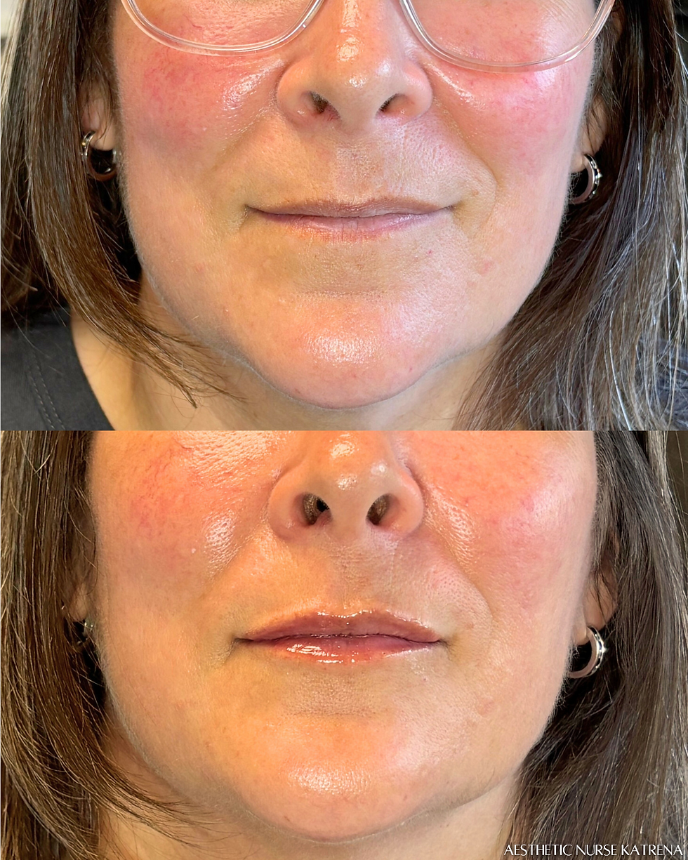 Mini Lip Filler near me Oshawa | Durham Region | Courtice | Whitby | Bowmanville | Orono | Ajax