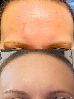 Botox Face at Rest near me Oshawa | Durham Region | Courtice | Whitby | Bowmanville | Orono | Ajax