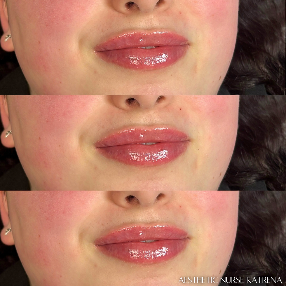 Mini Lip Filler Plump near me Oshawa | Durham Region | Courtice | Whitby | Bowmanville | Orono