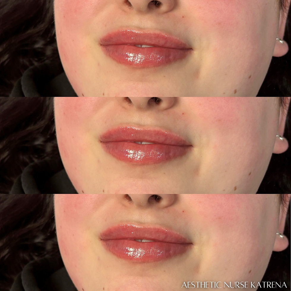 Mini Lip Filler Plump near me Oshawa | Courtice | Whitby | Bowmanville | Orono | Newcastle