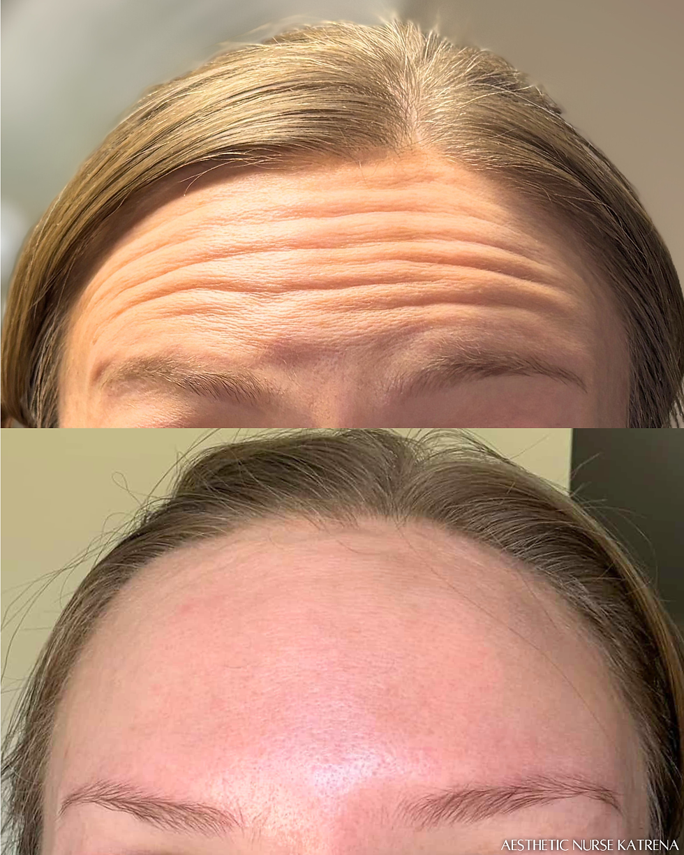 Forehead Lines Botox near me Oshawa | Durham Region | Courtice | Whitby | Bowmanville | Orono | Ajax